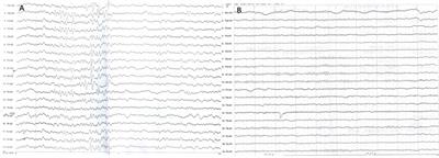 Cardiocerebral channelopathy caused by KCND3 mutation in a child: A case report